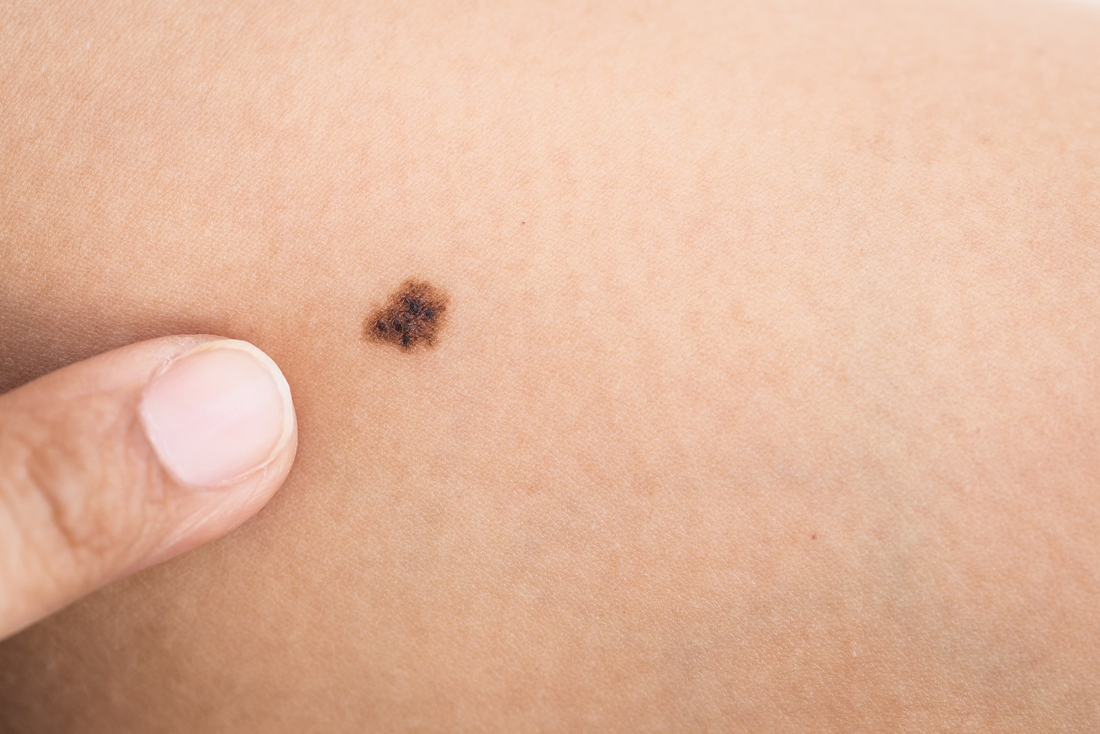 10 Things To Know About Skin Moles The Luxury Spot