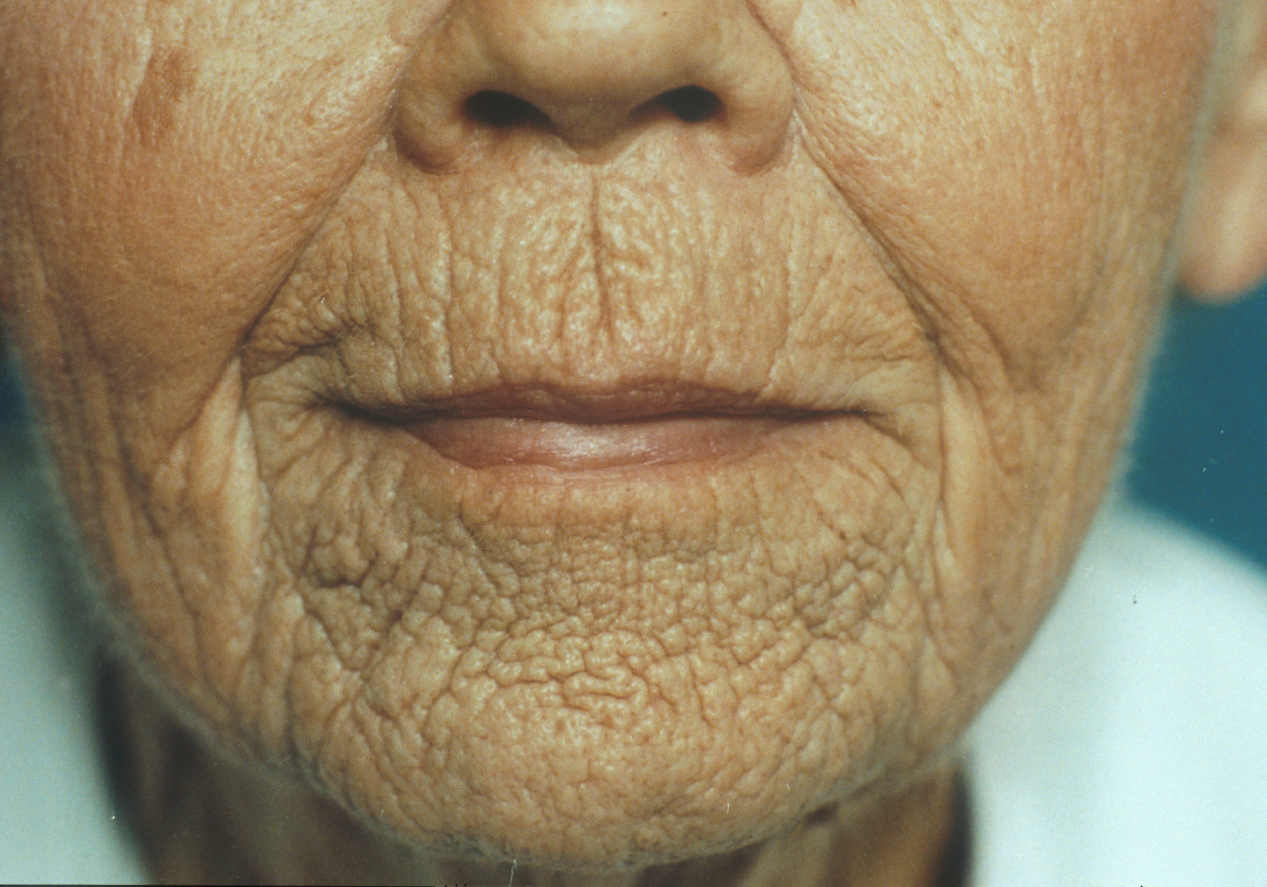 are-there-different-types-of-wrinkles-epiphany-dermatology