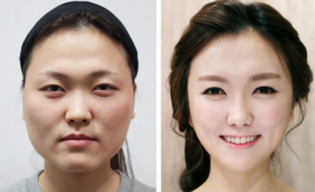 extreme plastic surgery Asia
