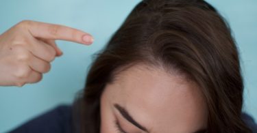 what causes scalp acne