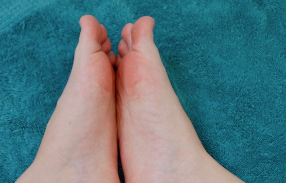 foot acne