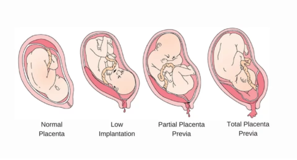 placenta previa degrees, placenta accreta