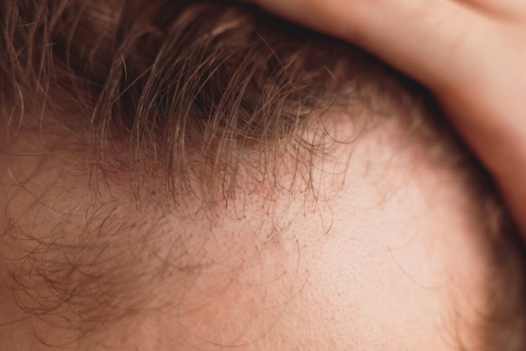 tips for fighting hair loss